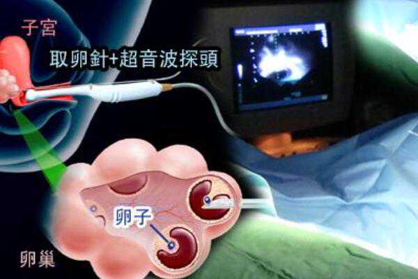 武汉找捐卵多少钱 武汉南医院做试管的具体花费是多少? ‘32周双顶径看男女’
